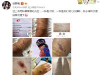 徐梦桃晒手术后伤口触目惊心 自嘲终于摆脱棉花腿